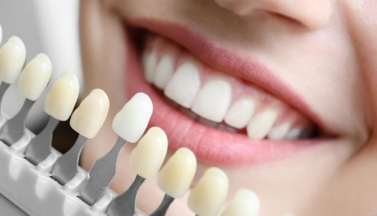 Dental Veneers